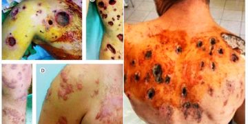 ISRAEL bombardea las inmediaciones de una escuela de la UNRWA con fósforo blanco